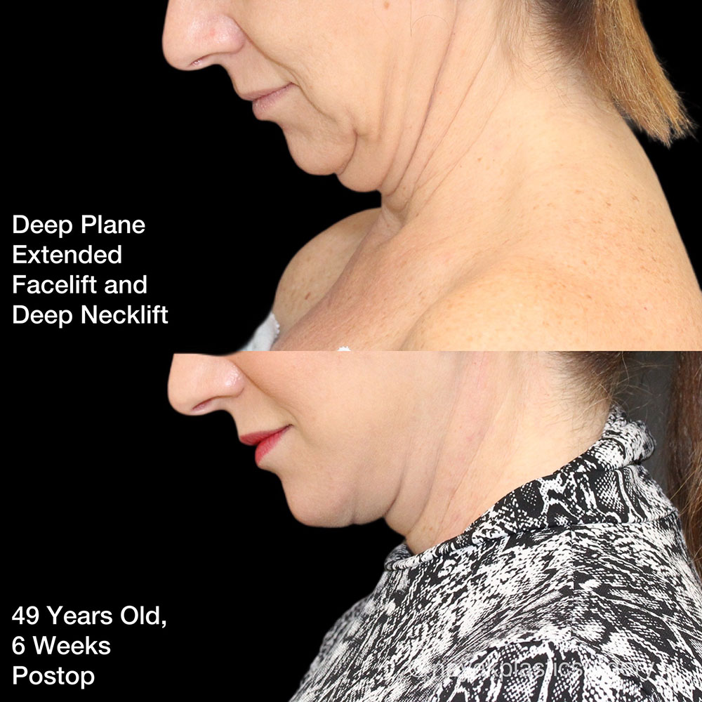 Facelift and Neck Before & After Image