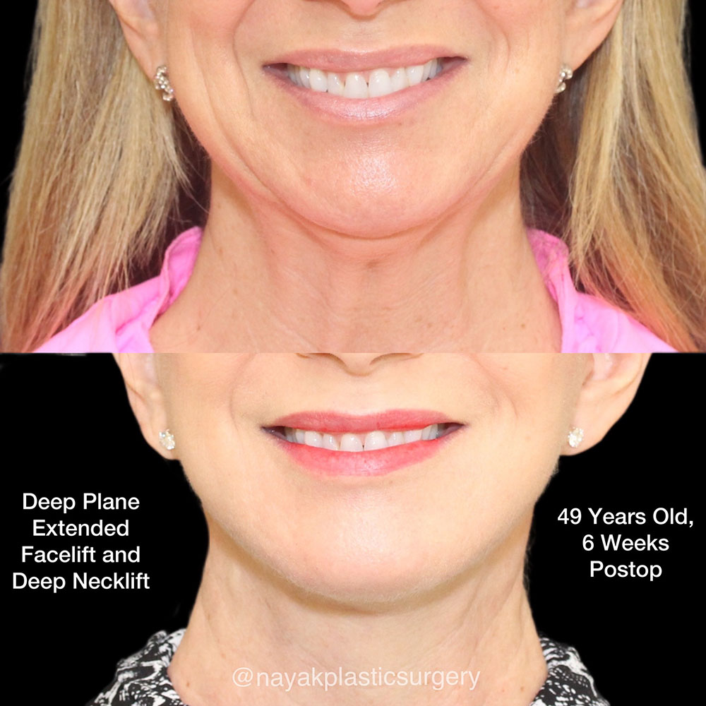 Facelift and Neck Before & After Image