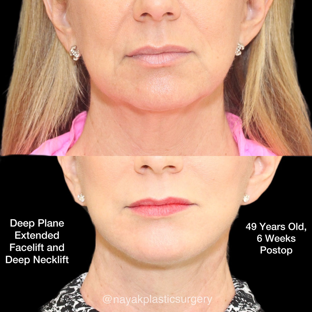 Facelift and Neck Before & After Image