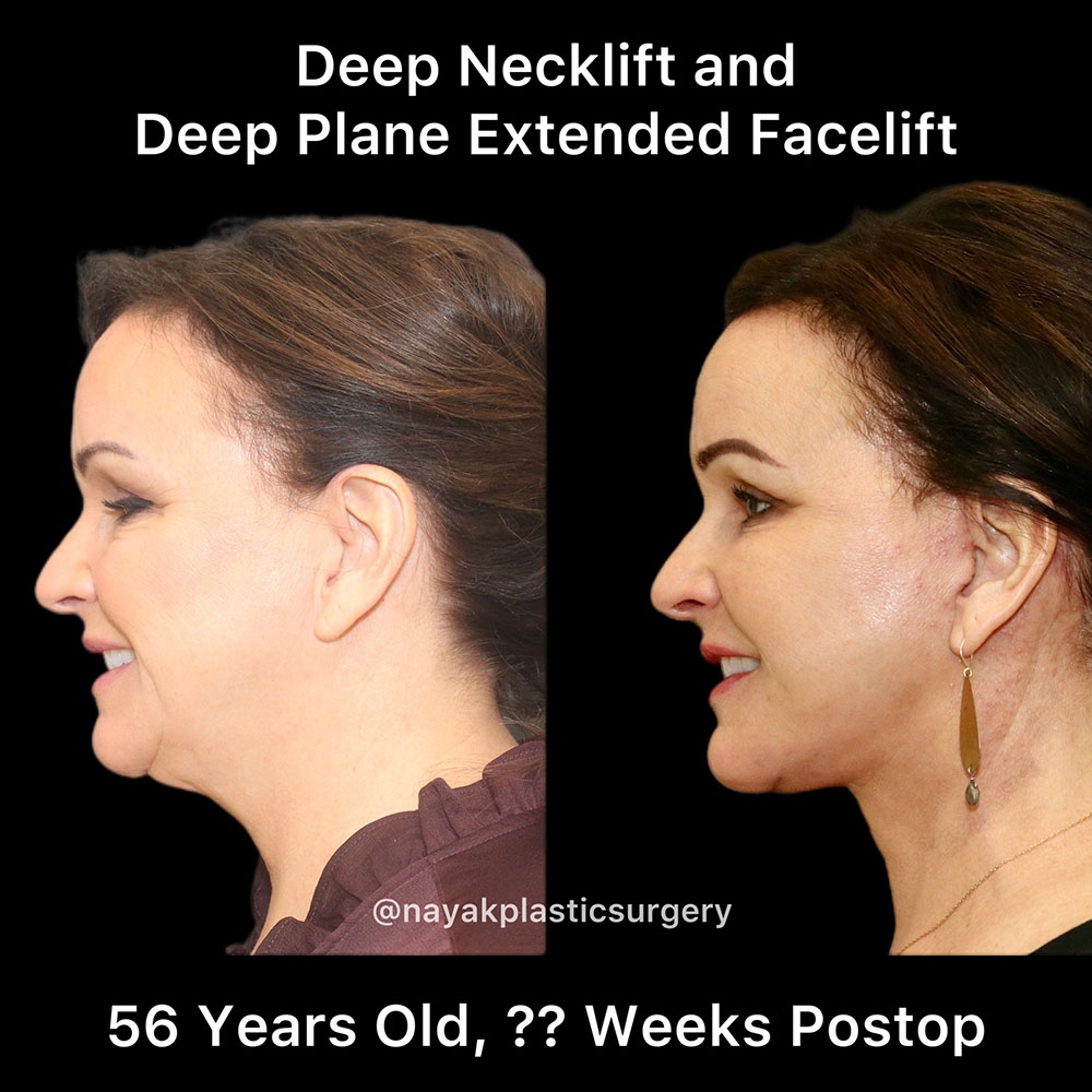 Facelift and Neck Before & After Image