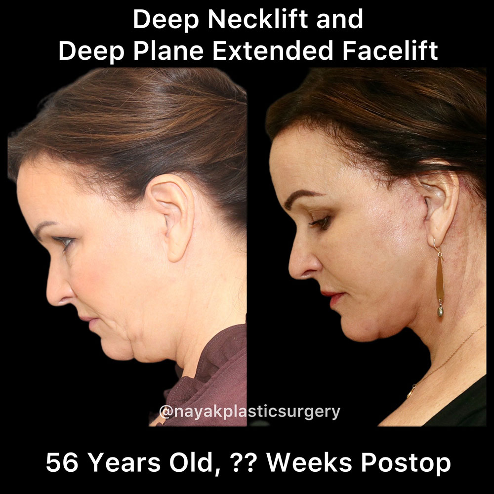 Facelift and Neck Before & After Image