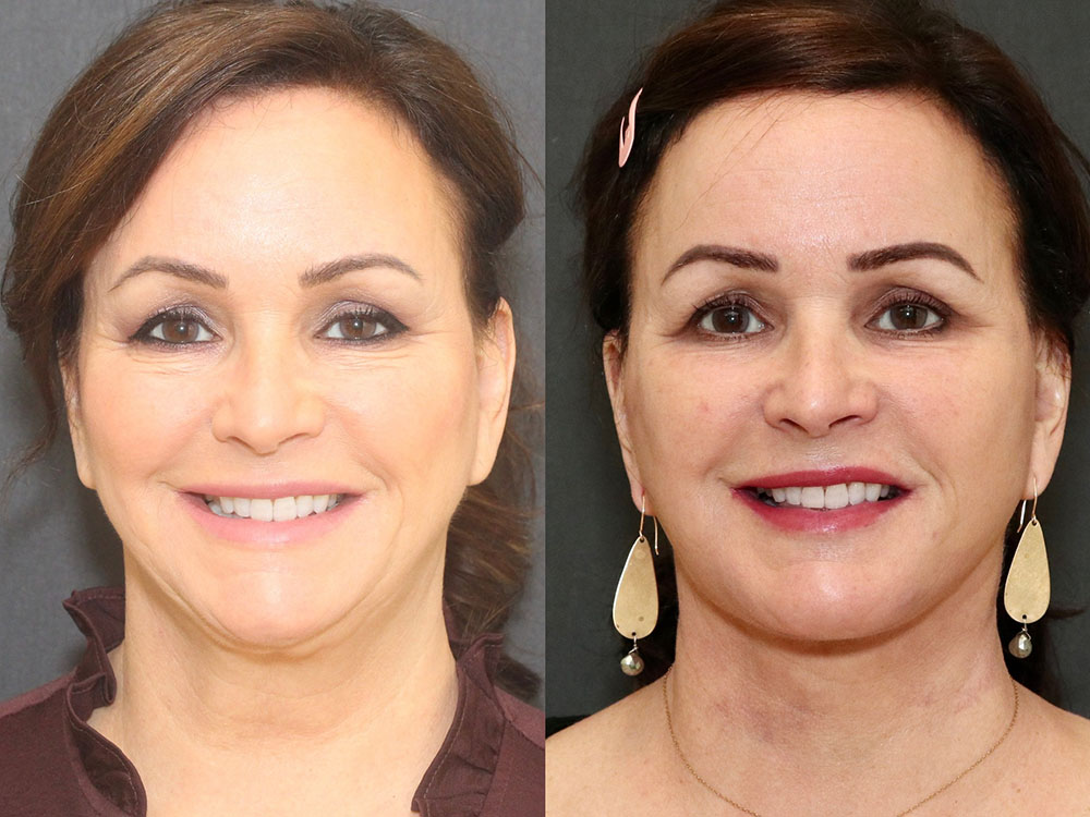 Facelift and Neck Before & After Image