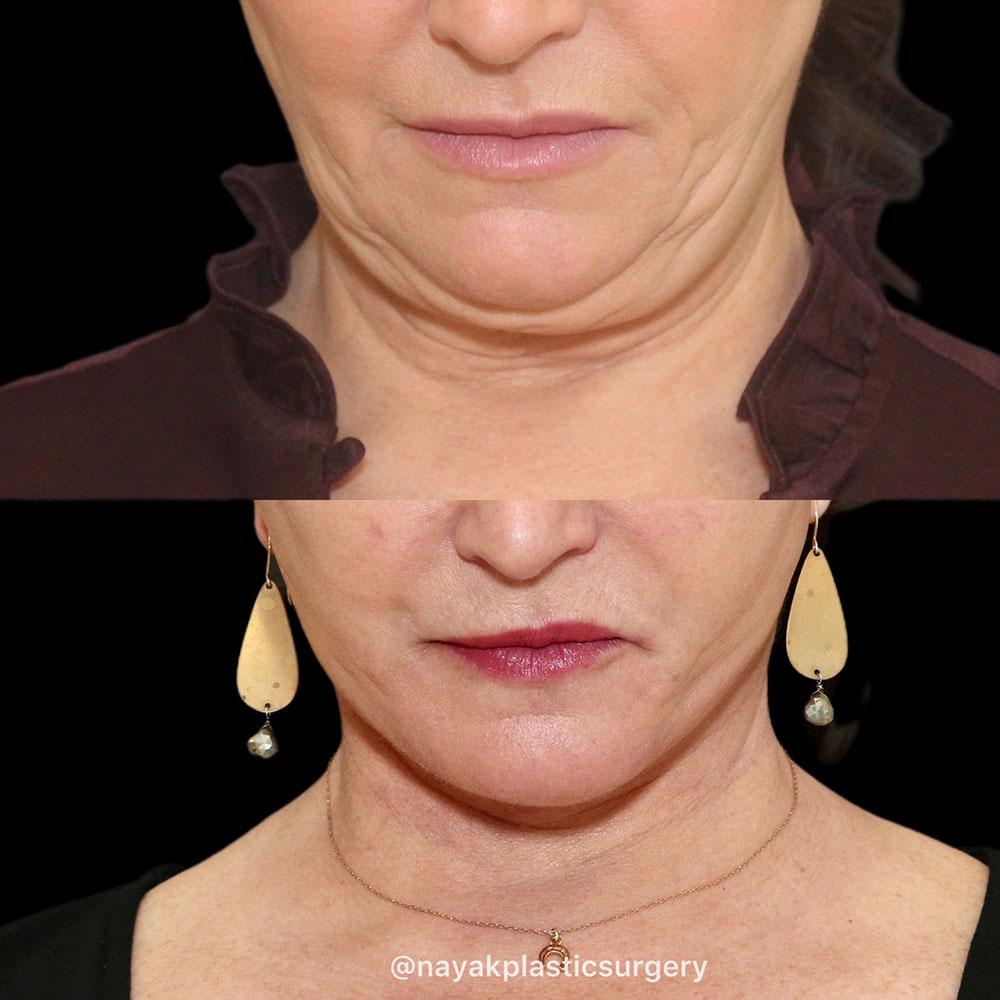 Facelift and Neck Before & After Image