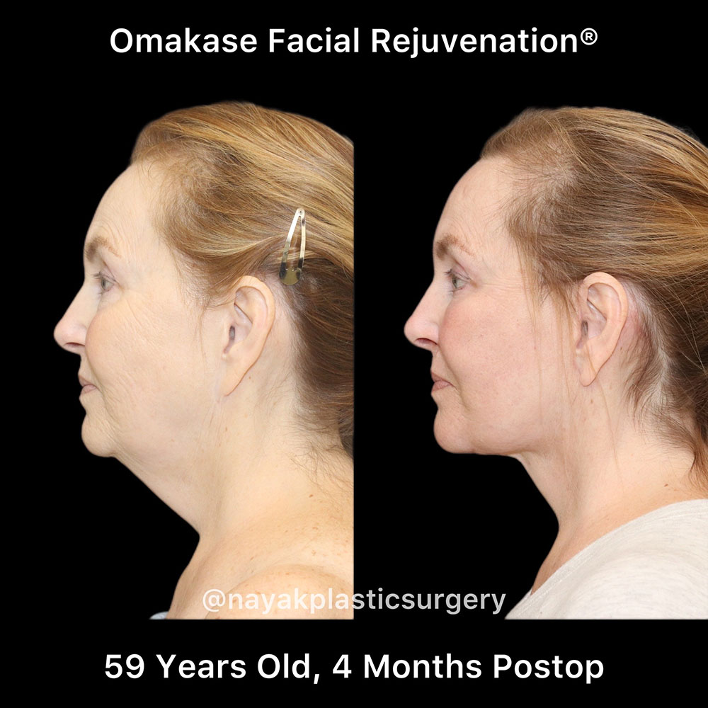 Facelift and Neck Before & After Image