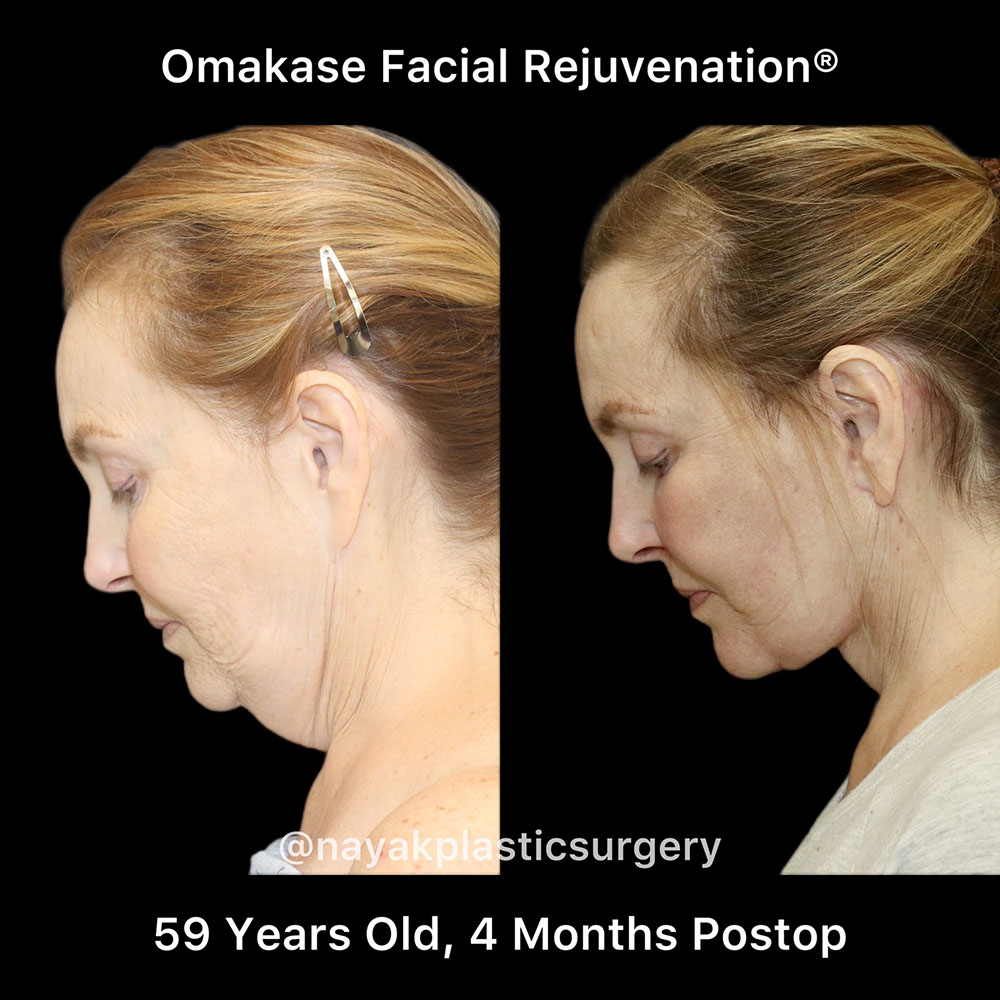 Facelift and Neck Before & After Image