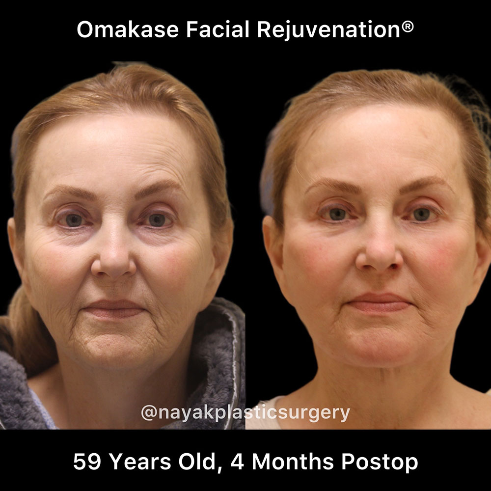 Facelift and Neck Before & After Image