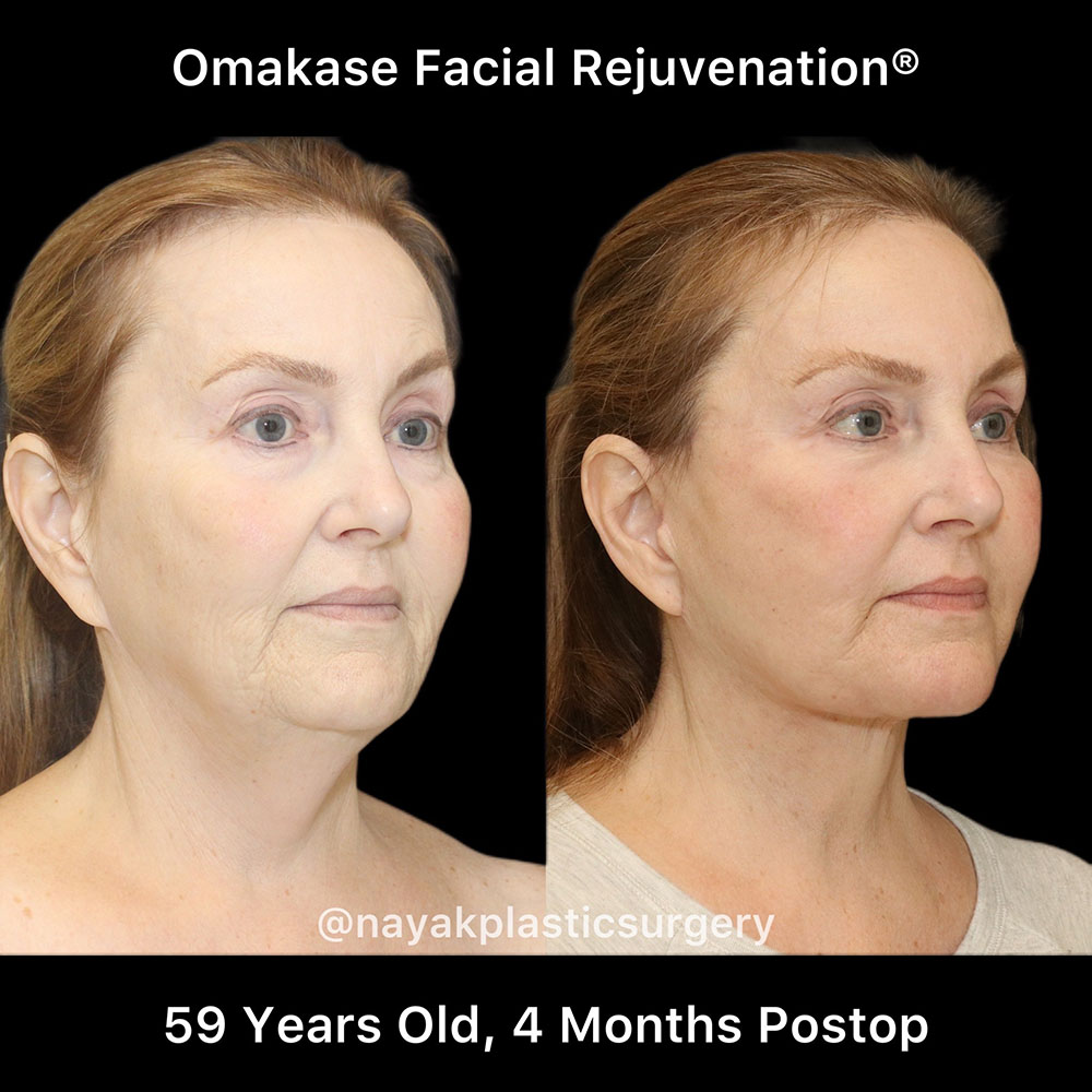 Facelift and Neck Before & After Image