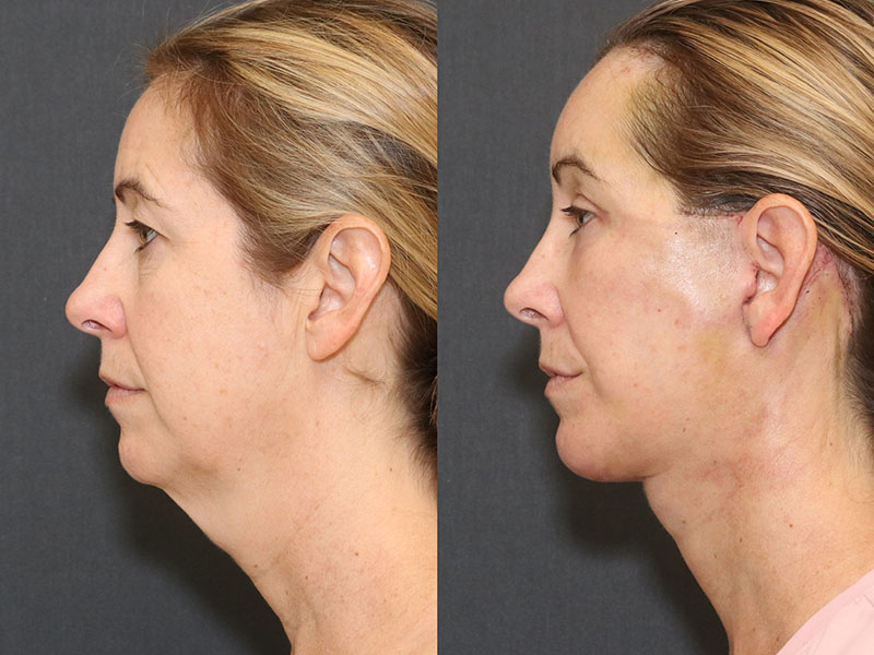 Facelift and Neck Before & After Image