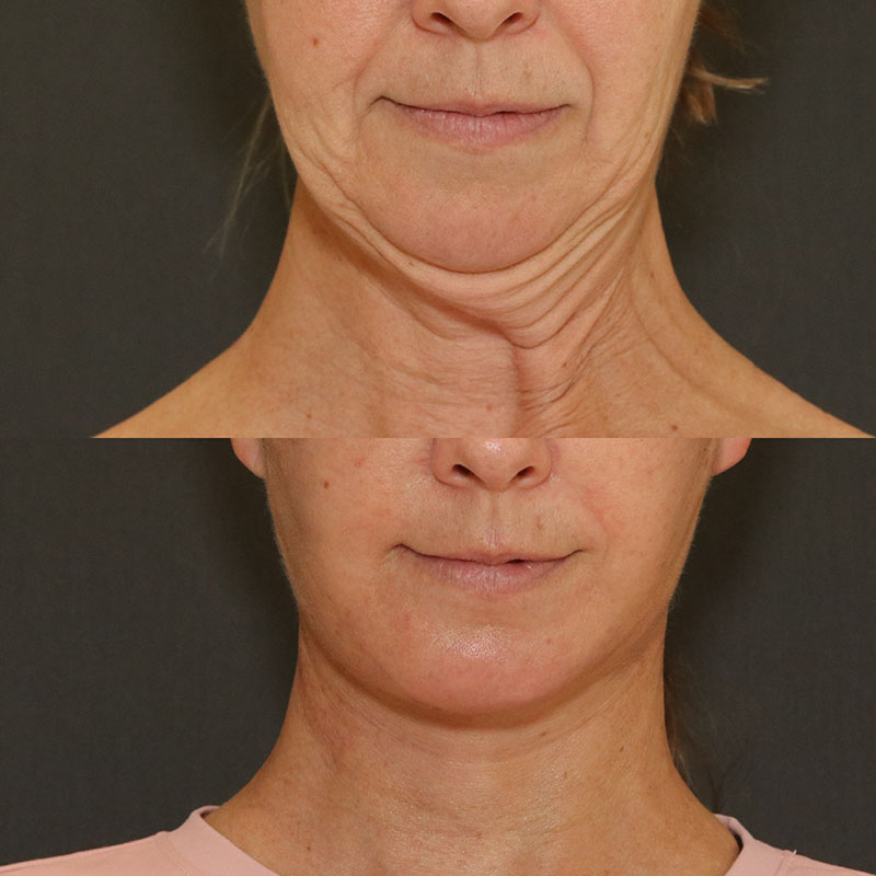 Facelift and Neck Before & After Image