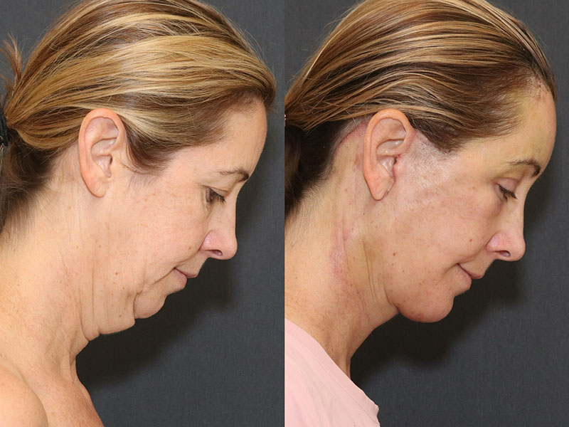 Facelift and Neck Before & After Image