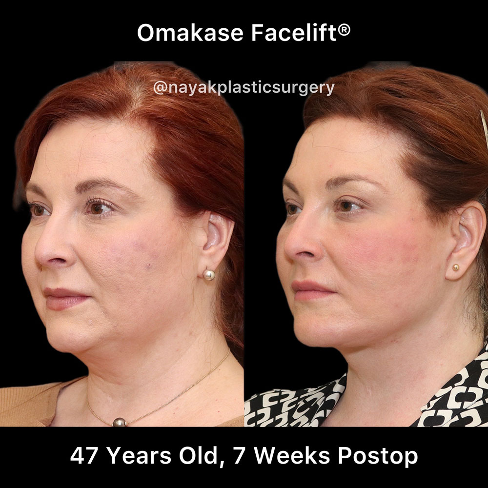 Facelift and Neck Before & After Image