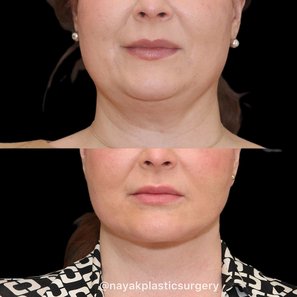 Facelift and Neck Before & After Image