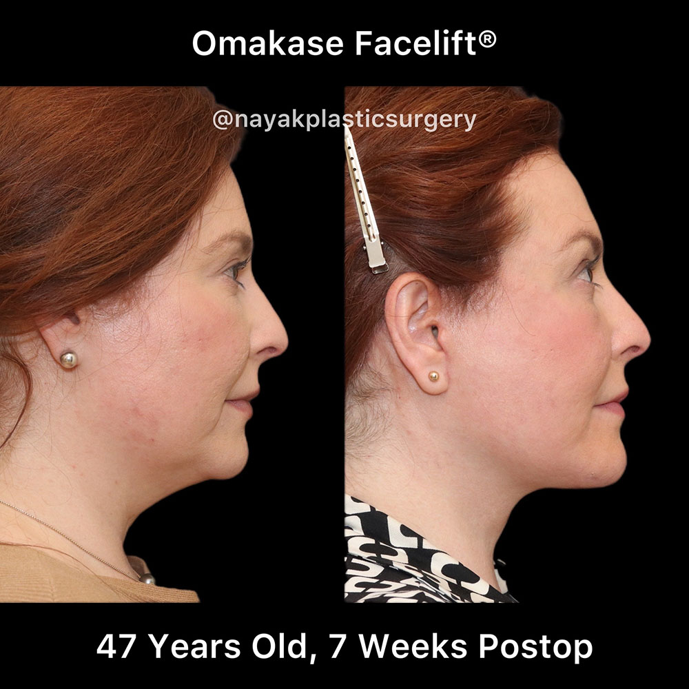 Facelift and Neck Before & After Image