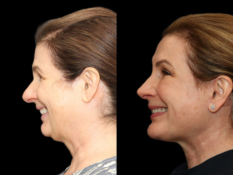 Facelift and Neck Before & After Image