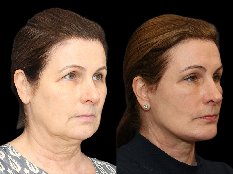 Facelift and Neck Before & After Image