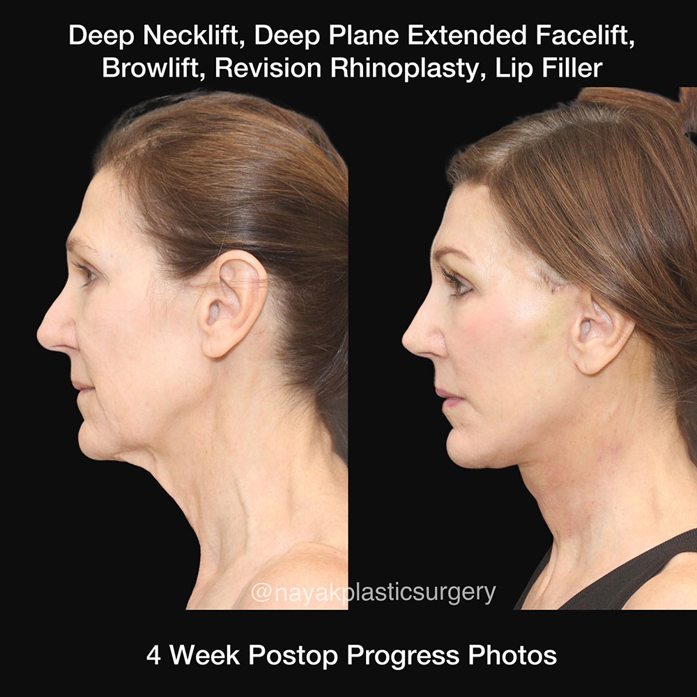 Facelift and Neck Before & After Image