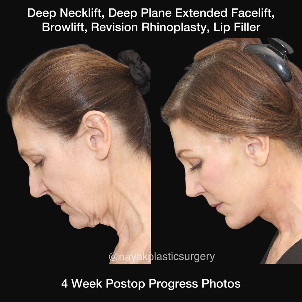 Facelift and Neck Before & After Image