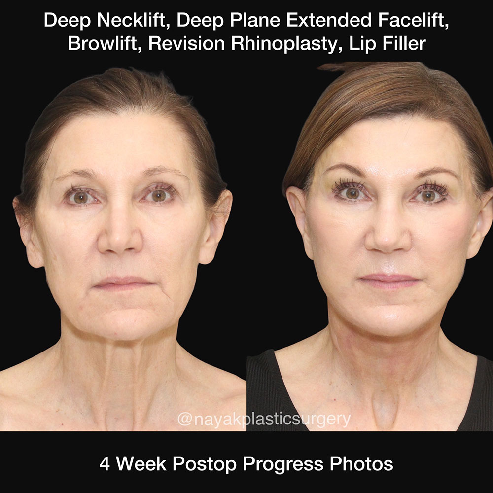 Facelift and Neck Before & After Image