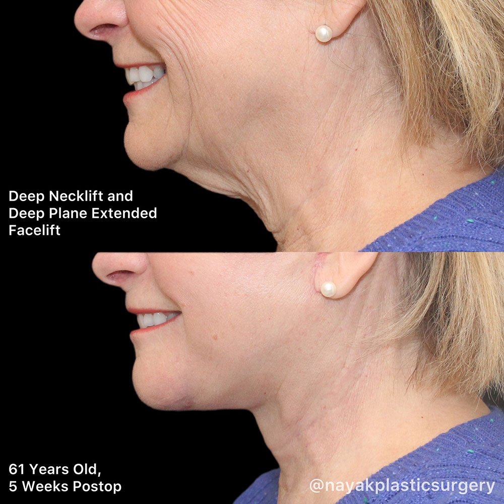 Facelift and Neck Before & After Image