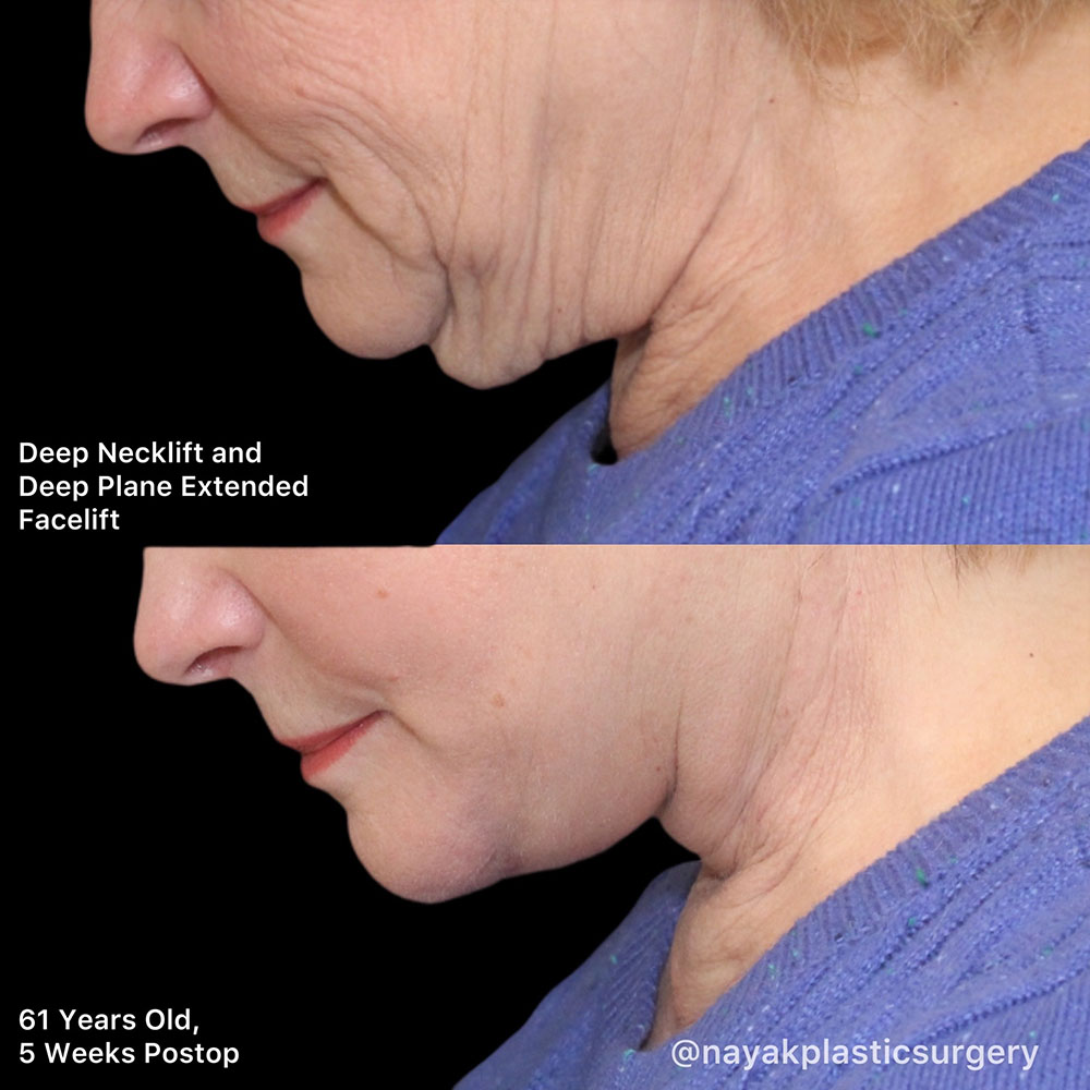 Facelift and Neck Before & After Image