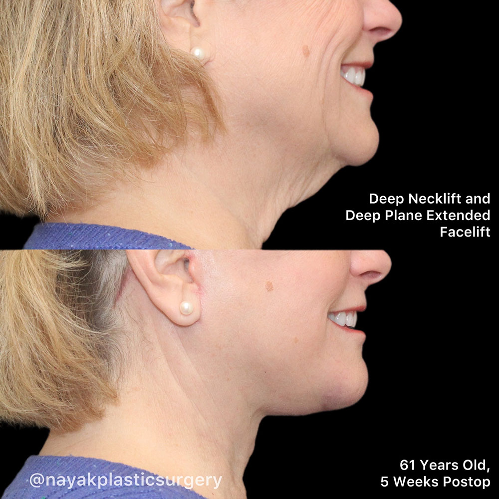 Facelift and Neck Before & After Image