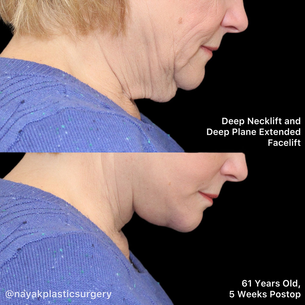 Facelift and Neck Before & After Image