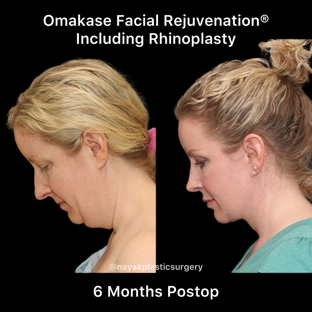 Facelift and Neck Before & After Image