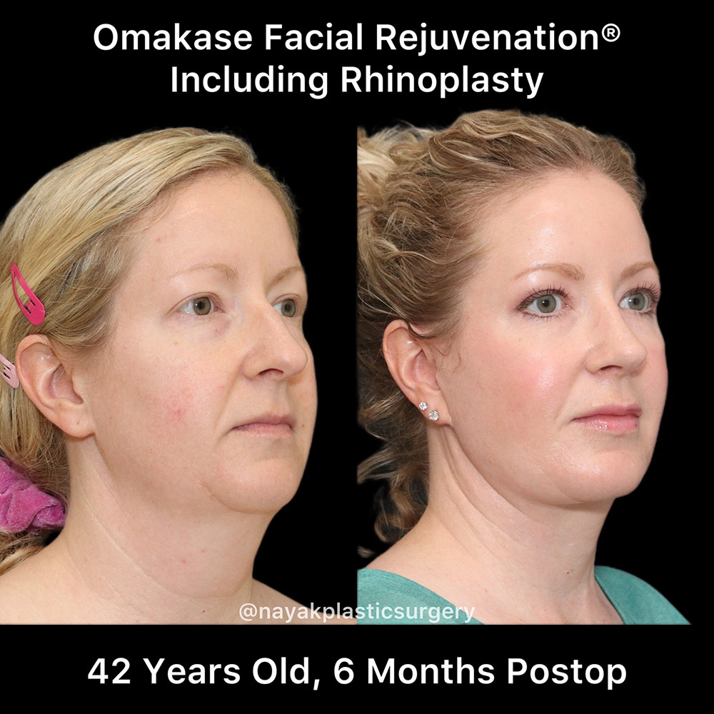 Facelift and Neck Before & After Image