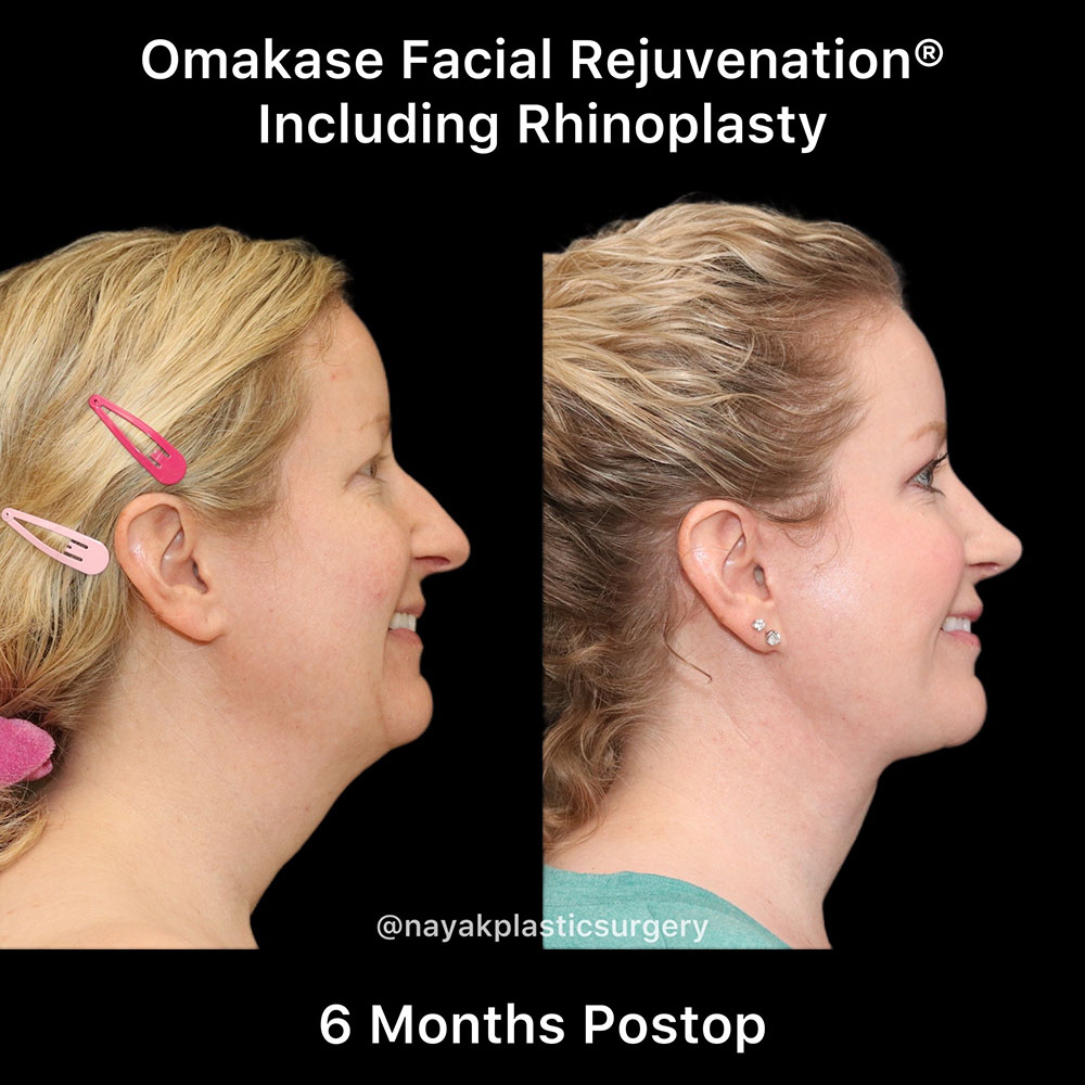 Facelift and Neck Before & After Image