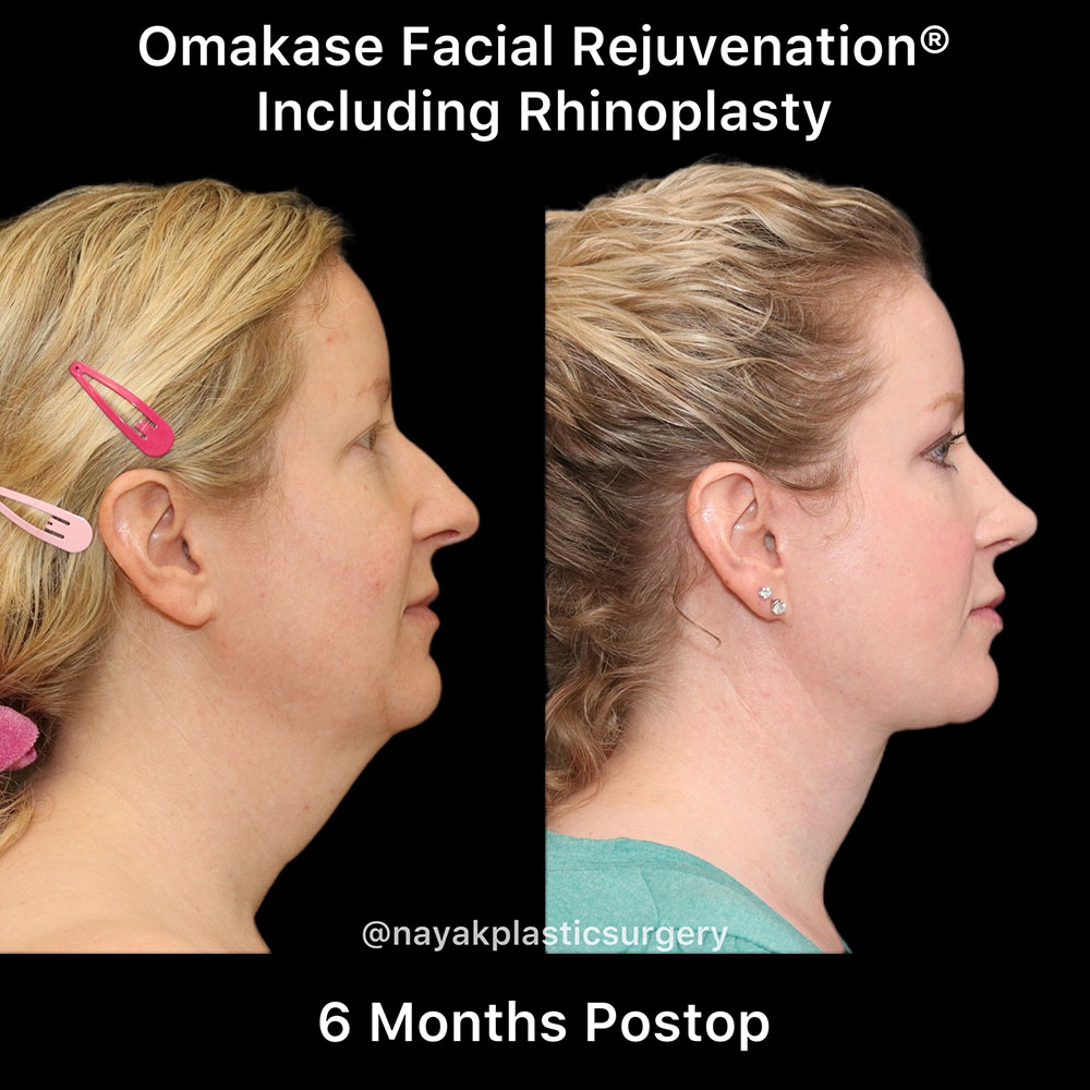 Facelift and Neck Before & After Image