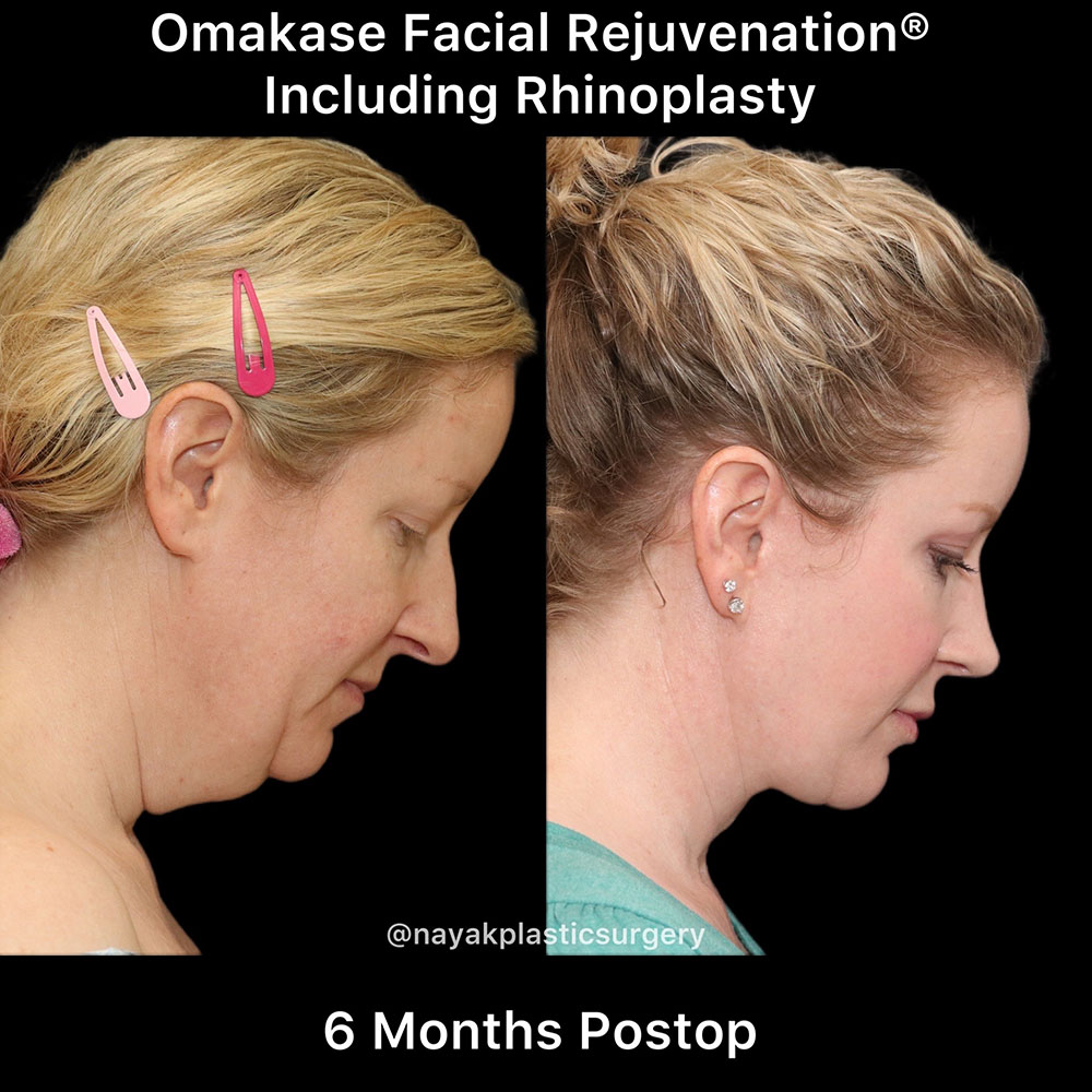 Facelift and Neck Before & After Image