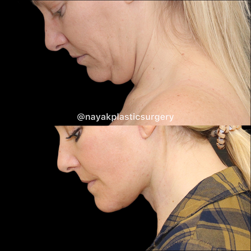 Facelift and Neck Before & After Image