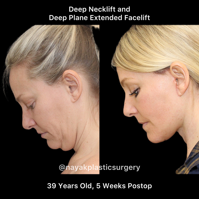 Facelift and Neck Before & After Image