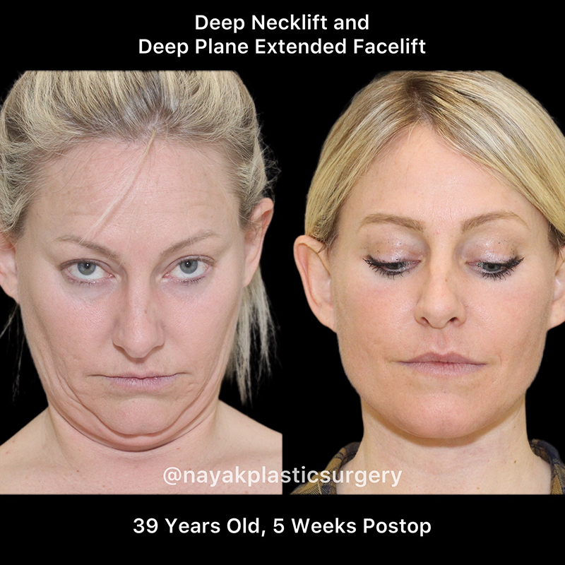 Facelift and Neck Before & After Image