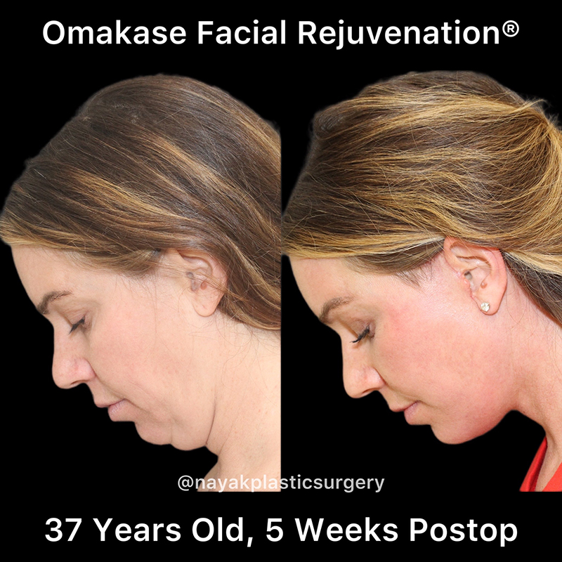 Facelift and Neck Before & After Image