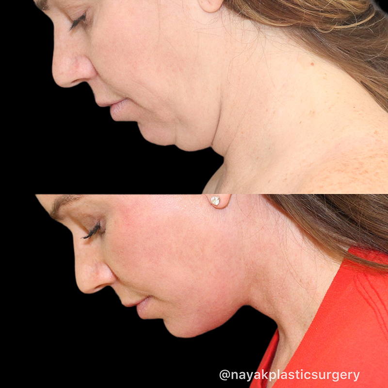 Facelift and Neck Before & After Image