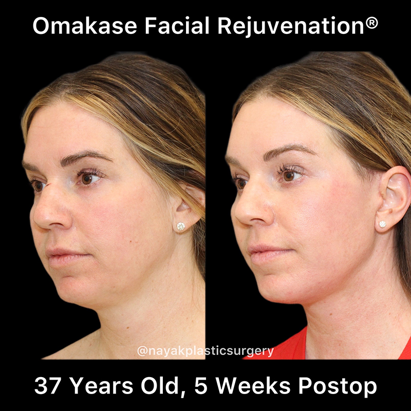 Facelift and Neck Before & After Image