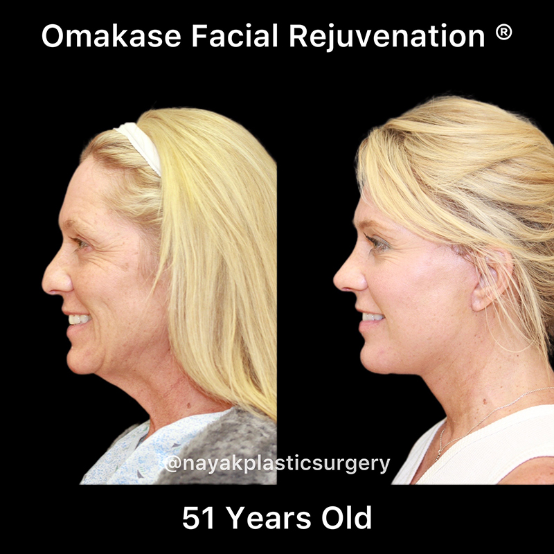 Facelift and Neck Before & After Image