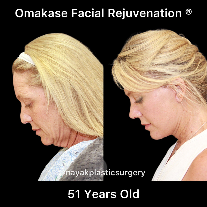 Facelift and Neck Before & After Image