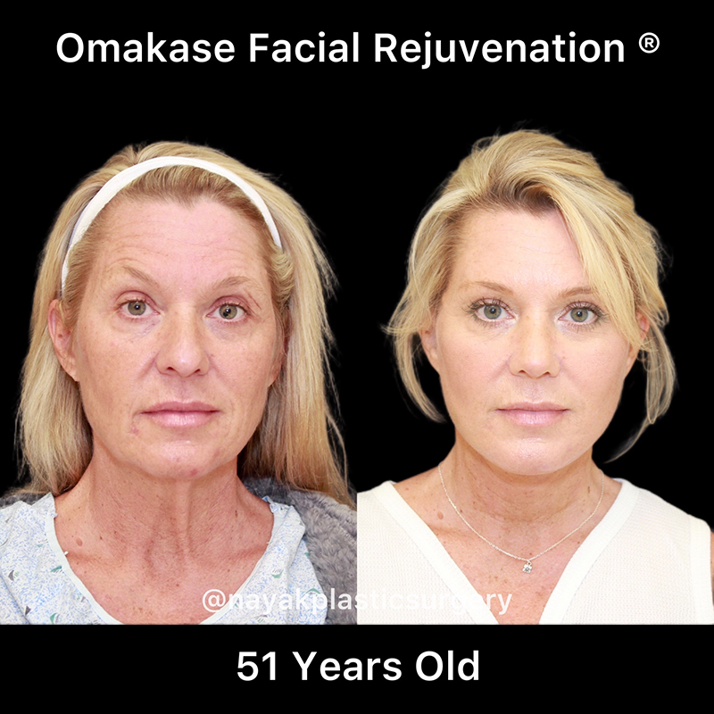 Facelift and Neck Before & After Image