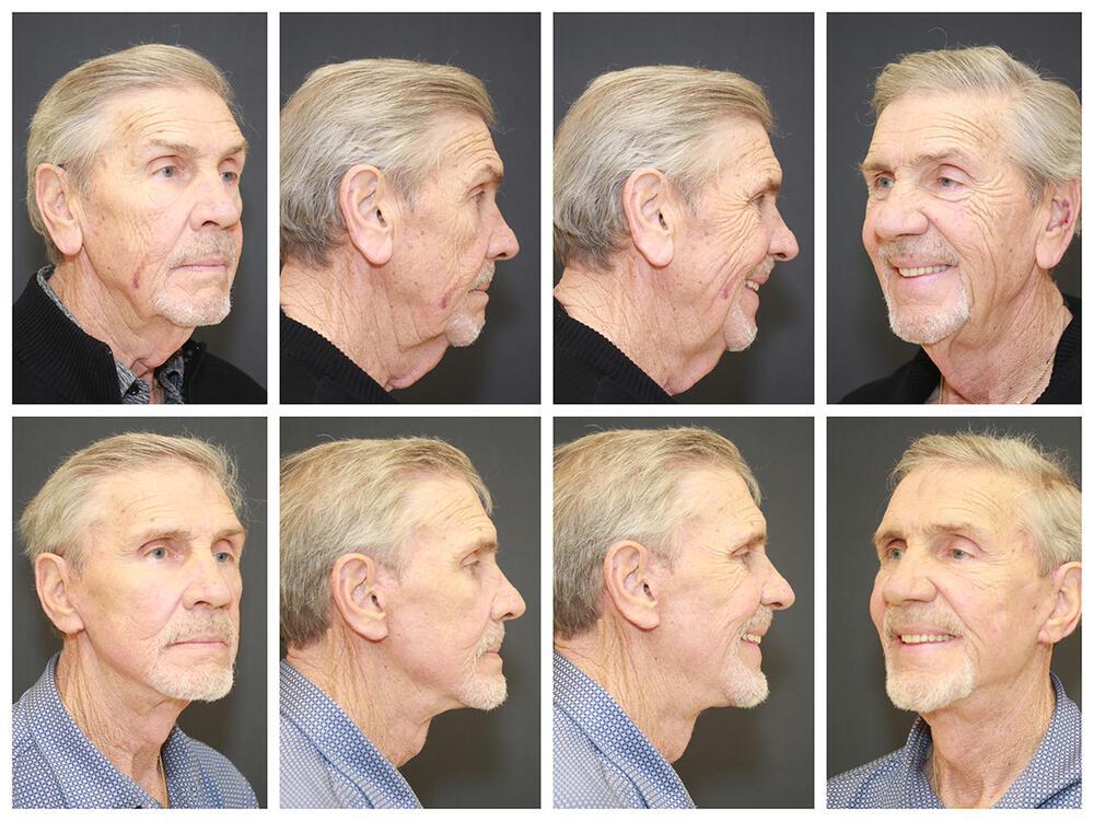 Fat Transfer Before & After Image