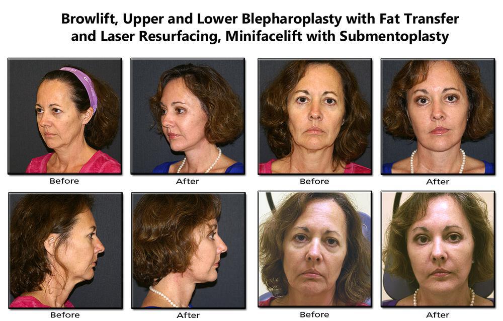 Fat Transfer Before & After Image