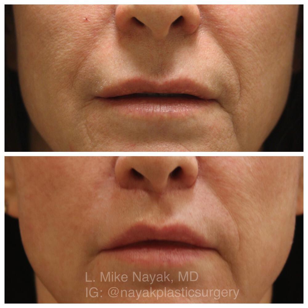 Lip Lift Before & After Image