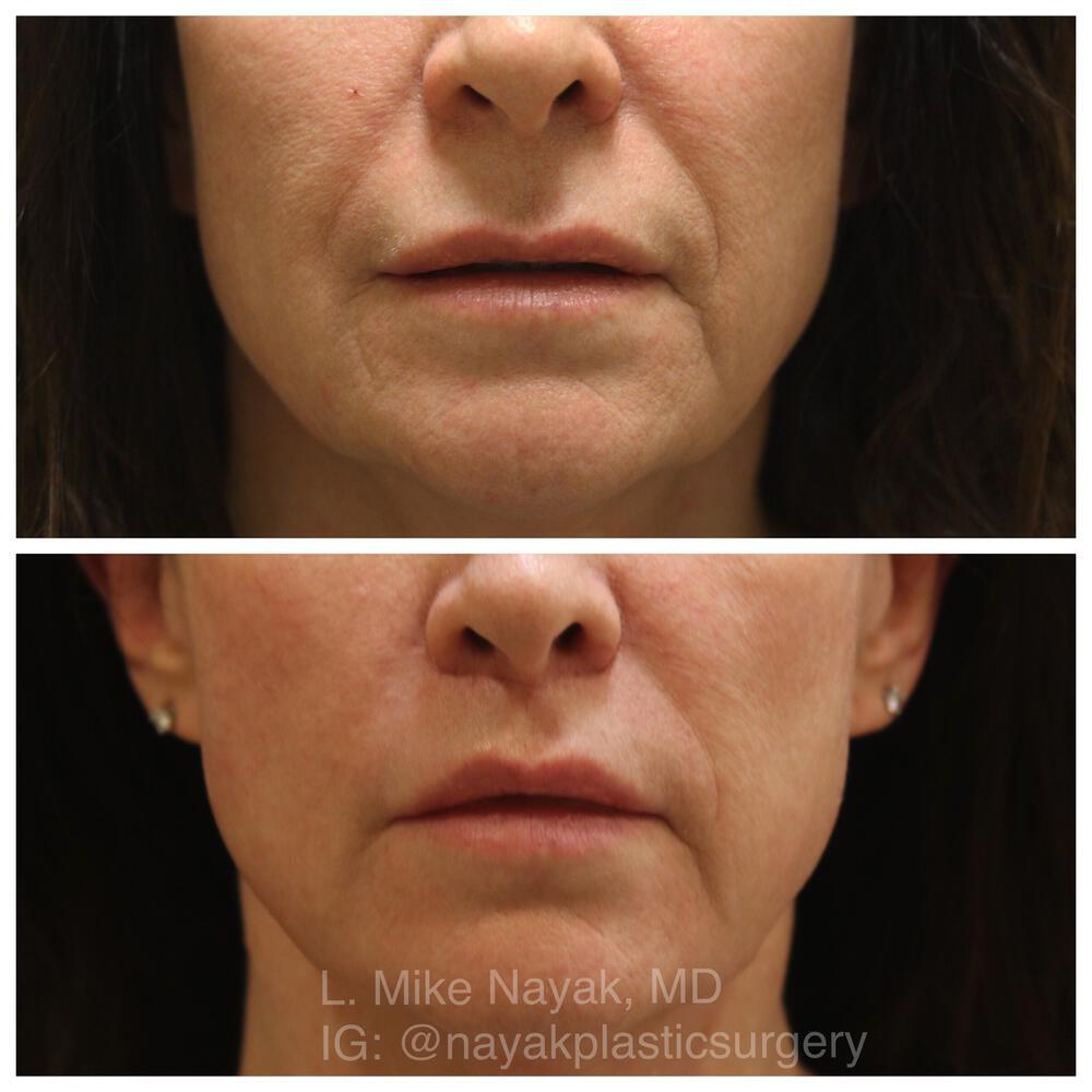 Lip Lift Before & After Image