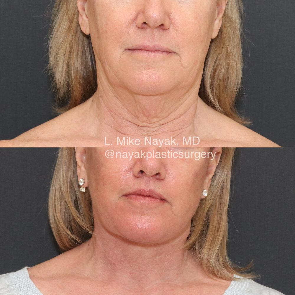 Lip Lift Before & After Image