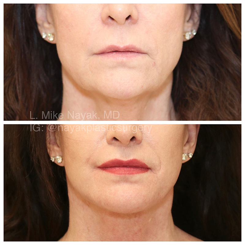 Lip Lift Before & After Image