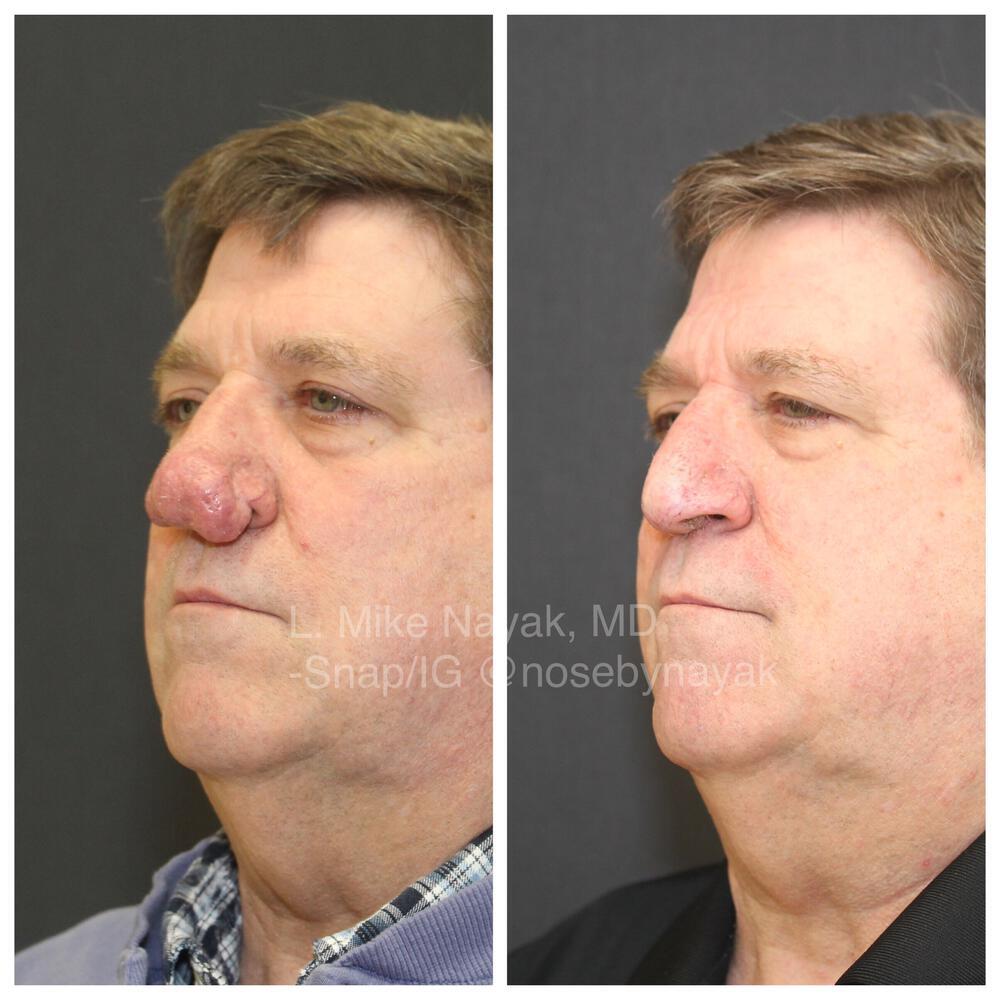 Rhinophyma Reduction Before & After Image