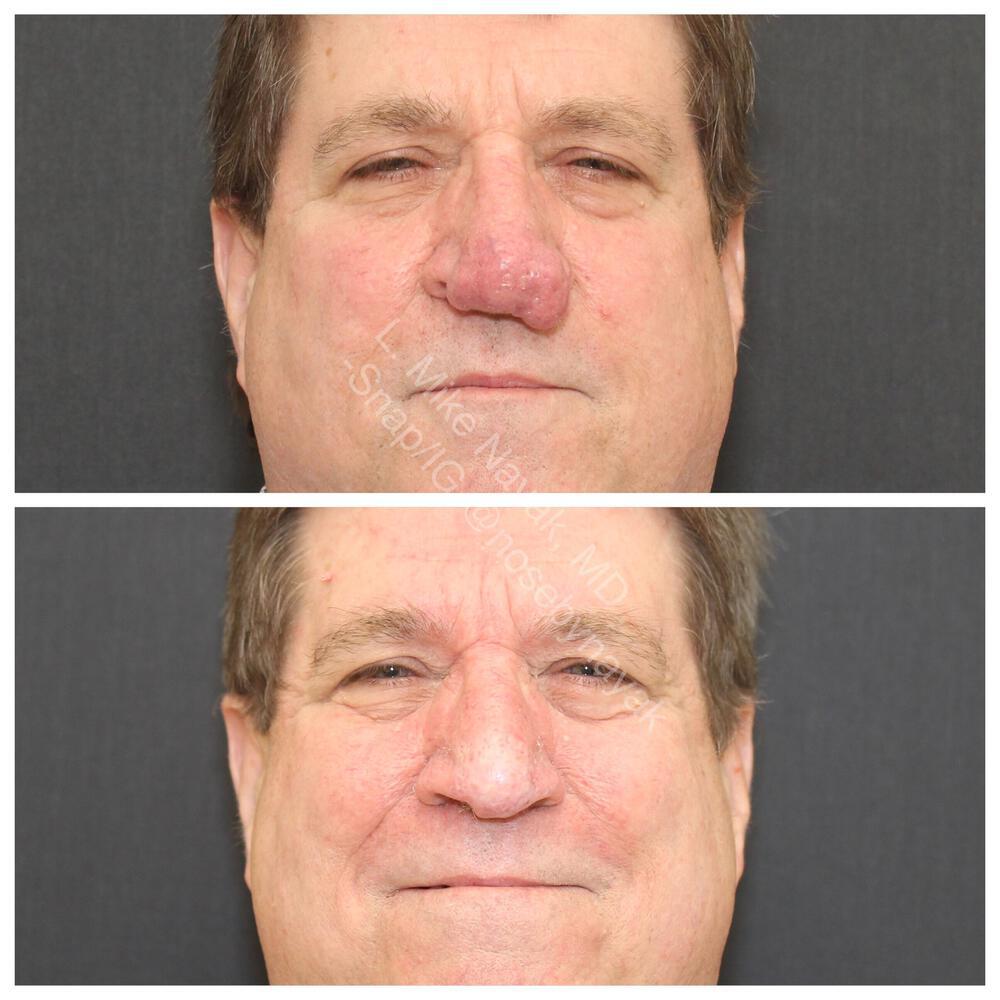 Rhinophyma Reduction Before & After Image