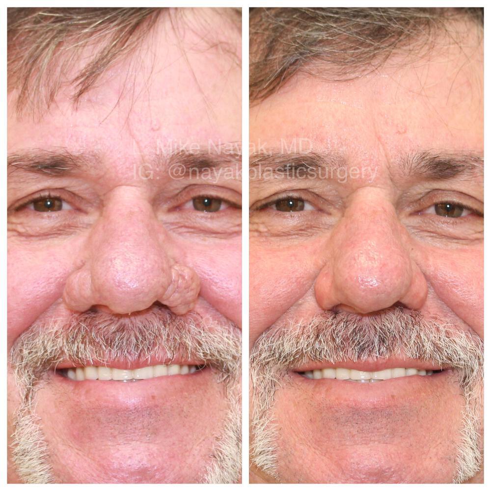 Rhinophyma Reduction Before & After Image