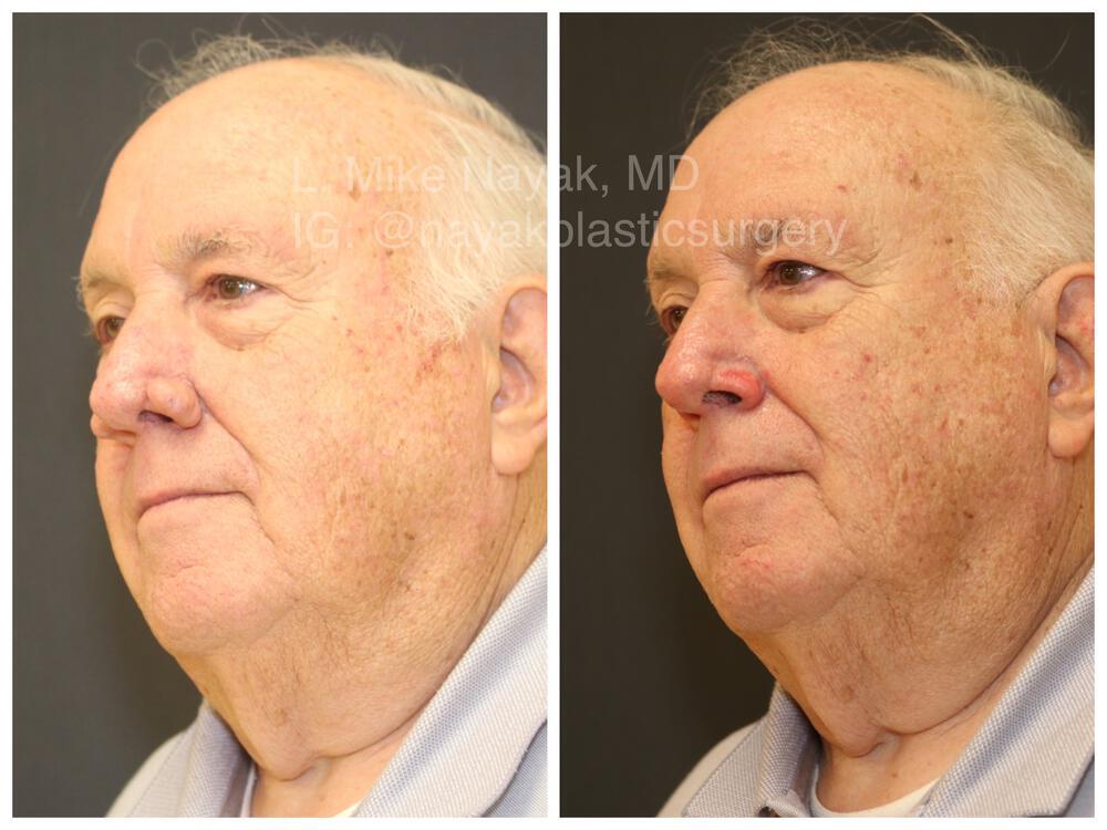 Rhinophyma Reduction Before & After Image